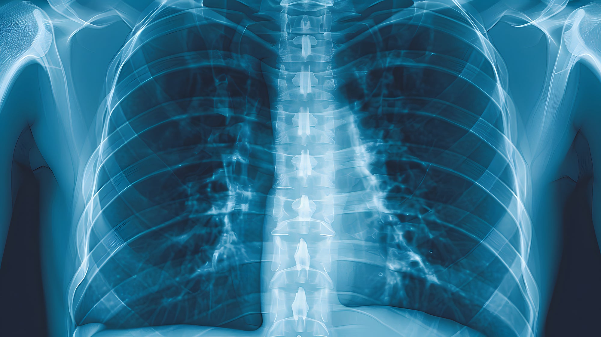 Xray of Ribs and Spine